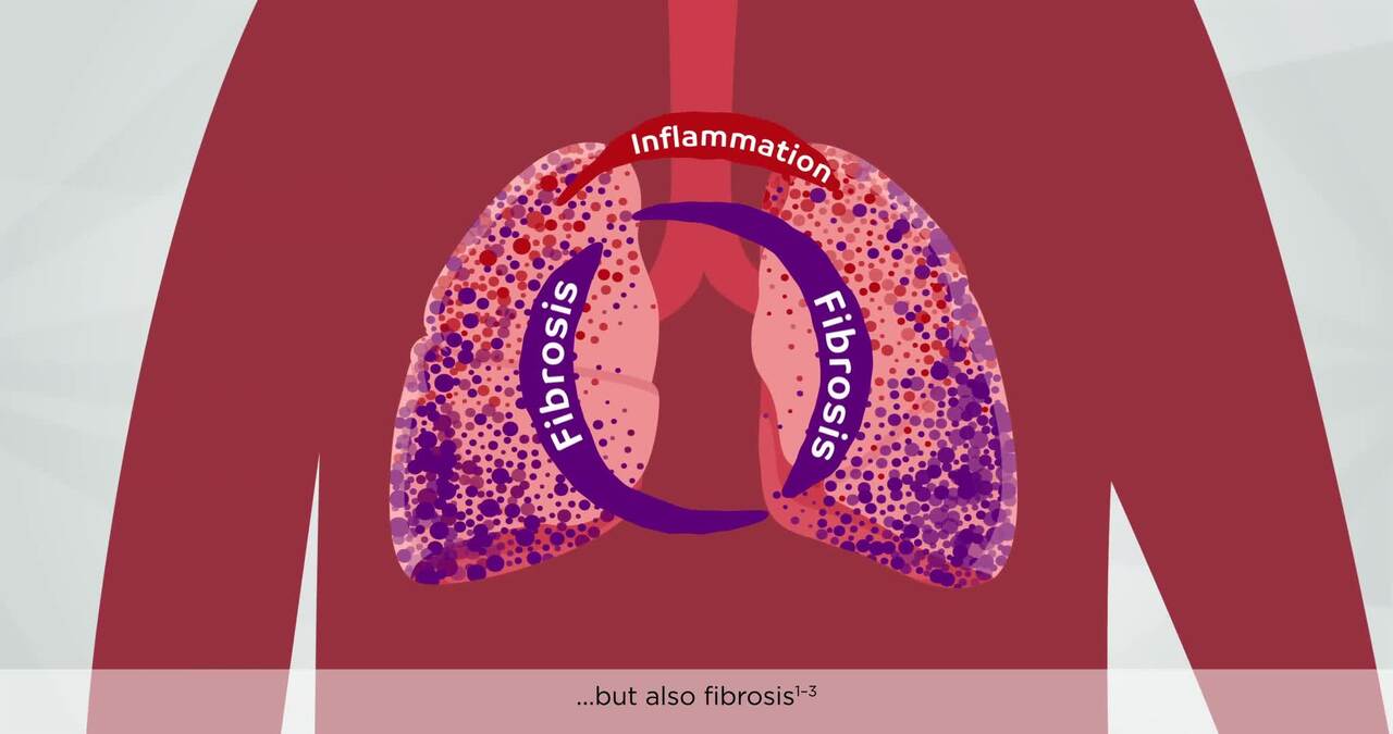 PC-SA-102509 Respiratory - Specialty OFEV