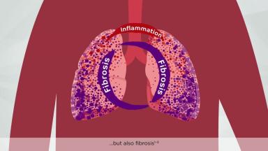 PC-SA-102509 Respiratory - Specialty OFEV